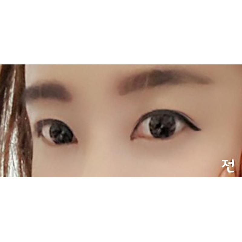 눈재수술 후기