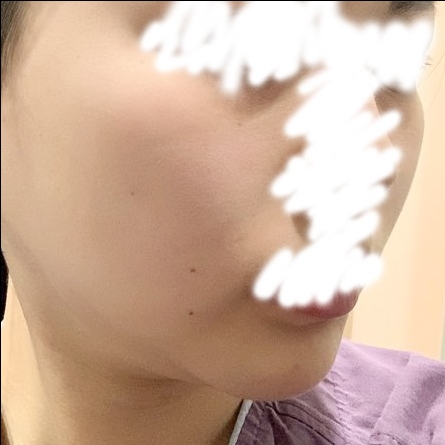 광대축소(앞광대) 후기