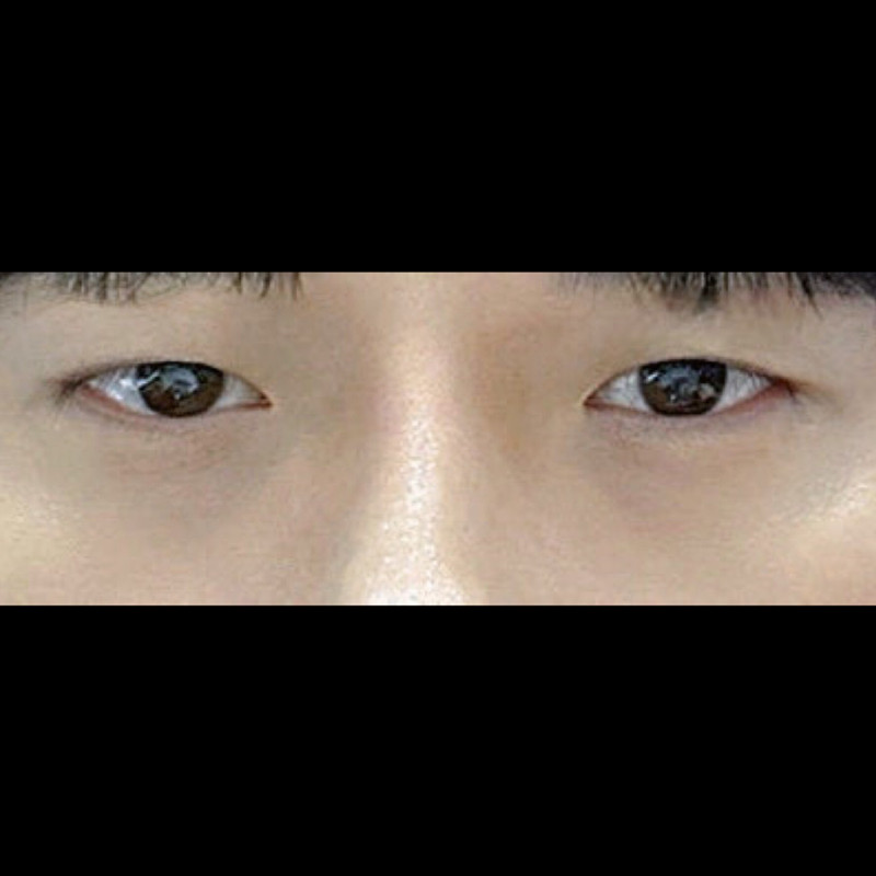 쌍꺼풀(매몰) 후기