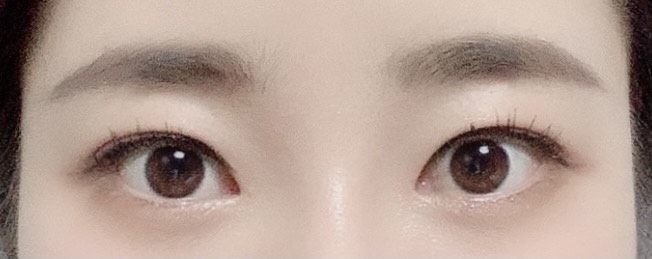쌍꺼풀(절개) 후기