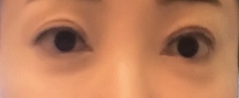 앞트임 후기