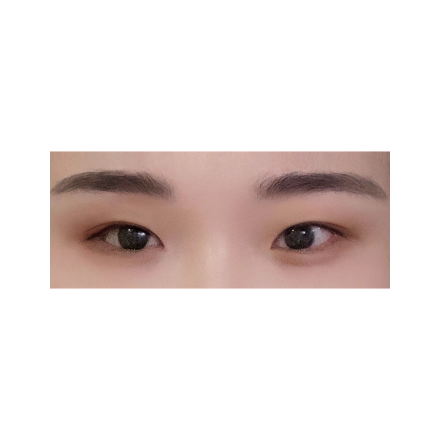 눈재수술 후기