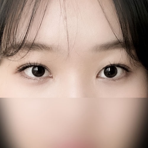 눈재수술 후기