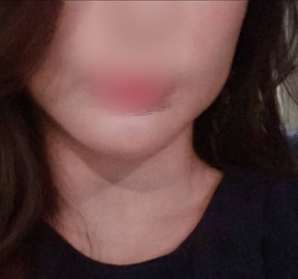 실리프팅 후기