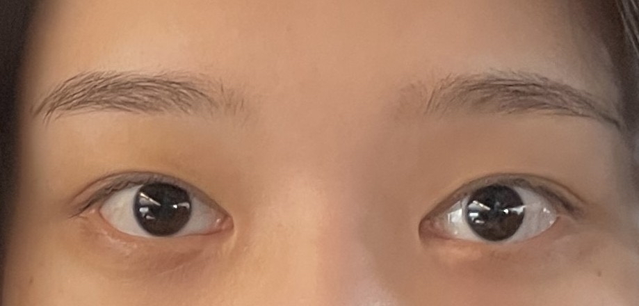 눈재수술 후기