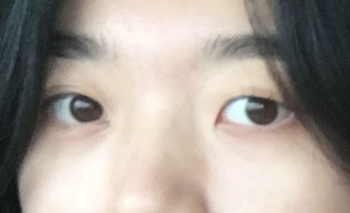 쌍꺼풀(자연유착) 후기