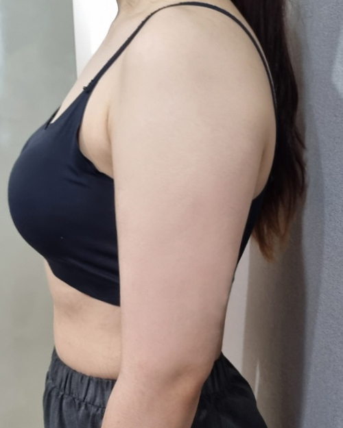 팔지방흡입 후기