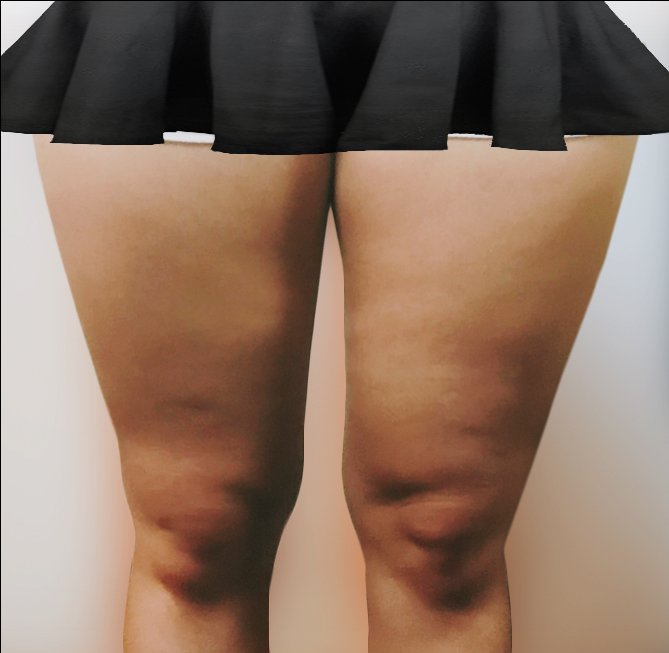 허벅지지방흡입 후기