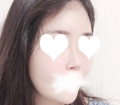 콧대(자가조직) 후기
