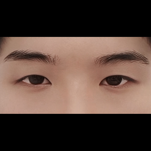 쌍꺼풀(절개) 후기