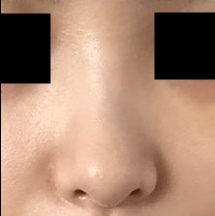코길이연장술 후기
