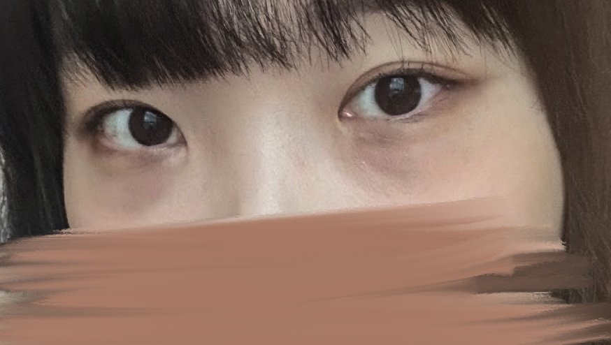 쌍꺼풀(절개) 후기