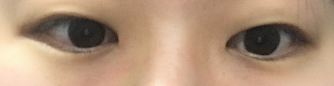 쌍꺼풀(절개) 후기