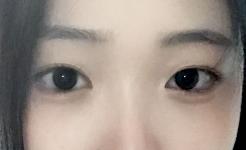 쌍꺼풀(자연유착) 후기