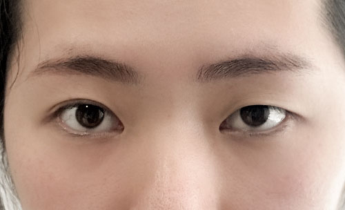 쌍꺼풀(자연유착) 후기