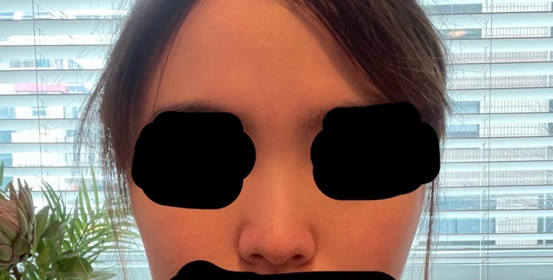 콧대(보형물) 후기