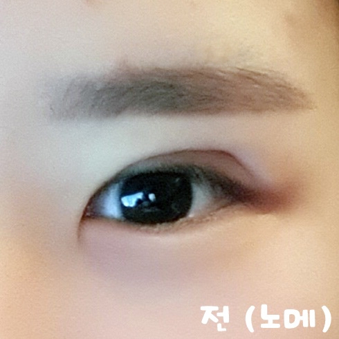 눈재수술 후기