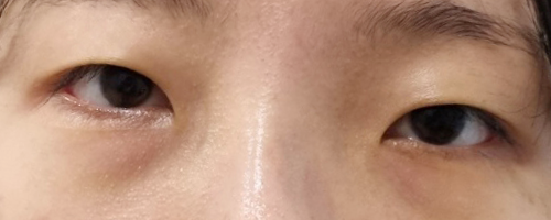 쌍꺼풀(절개) 후기