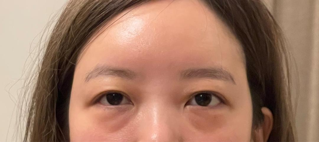 눈밑지방재배치 후기