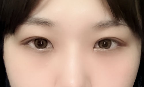 눈재수술 후기