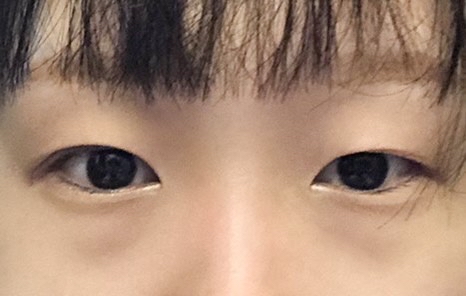 쌍꺼풀(절개) 후기