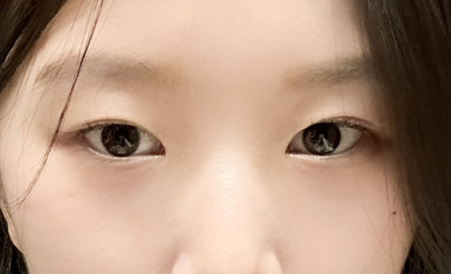 쌍꺼풀(자연유착) 후기