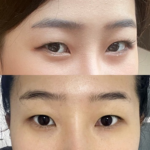 쌍꺼풀(절개) 후기