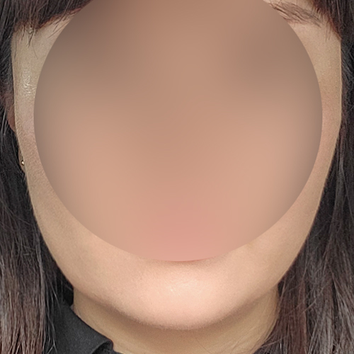 실리프팅 후기