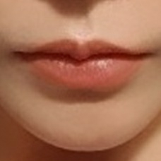 입꼬리성형 후기