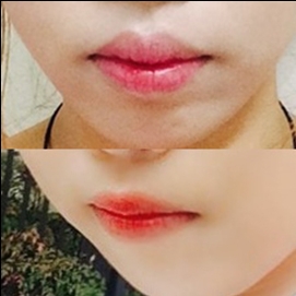 입꼬리성형 후기