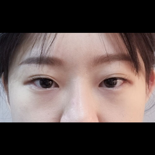쌍꺼풀(자연유착) 후기