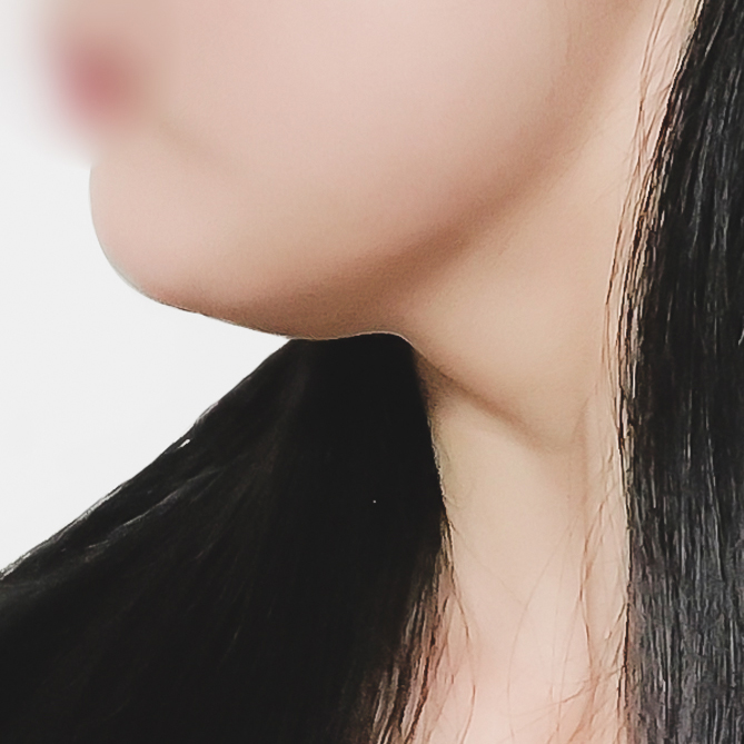 이중턱지방흡입 후기