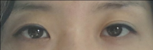 쌍꺼풀(절개) 후기