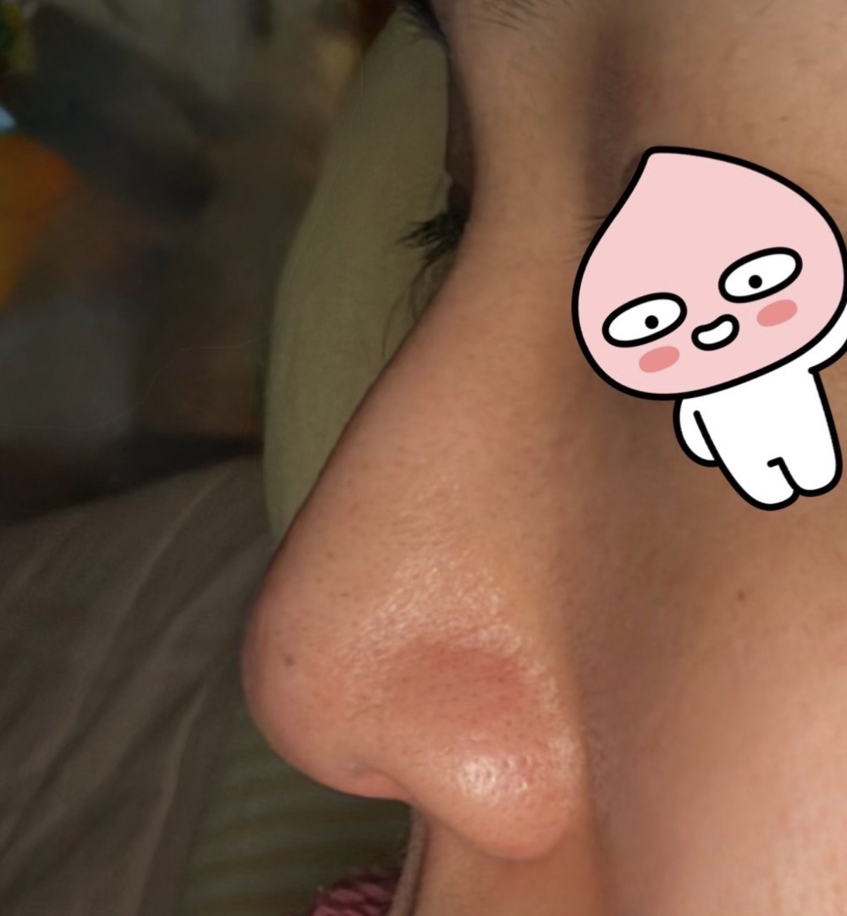 콧대(보형물) 후기