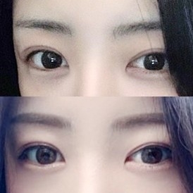 눈재수술 후기