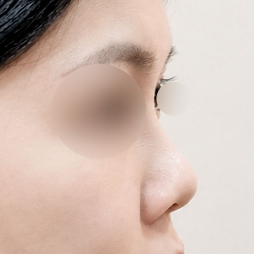 코재수술 후기