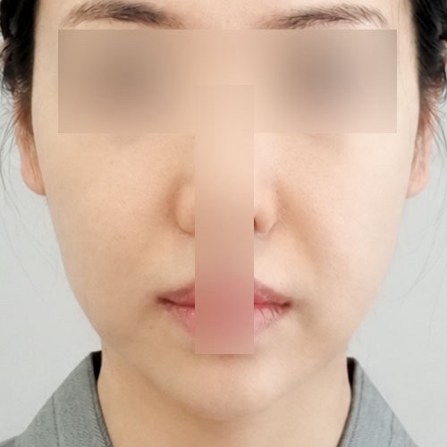 실리프팅 후기