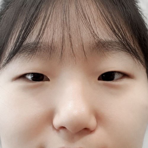 쌍꺼풀(자연유착) 후기