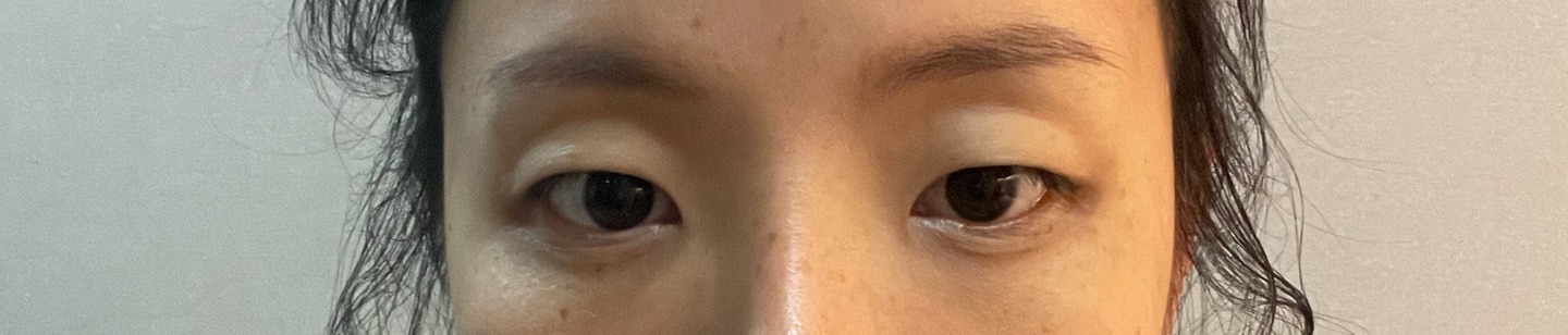 쌍꺼풀(절개) 후기