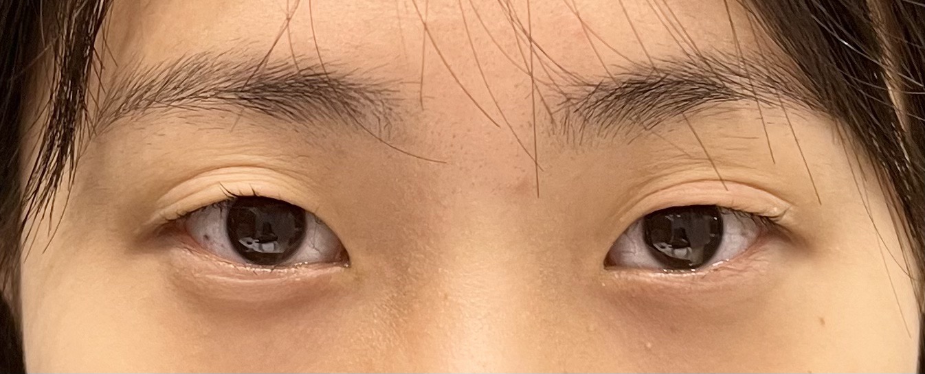 쌍꺼풀(매몰) 후기