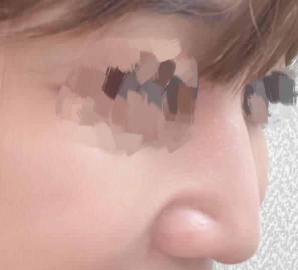 매부리코성형 후기