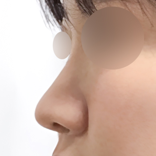 코재수술 후기