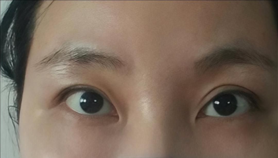 눈재수술 후기