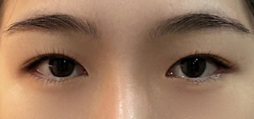 눈재수술 후기