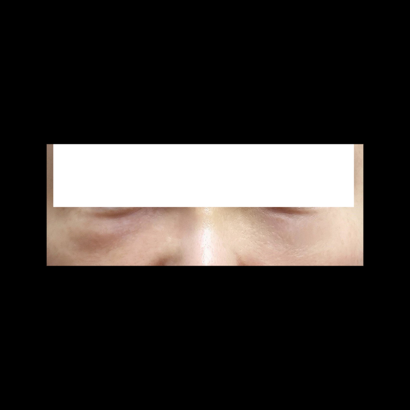 눈밑지방제거 후기