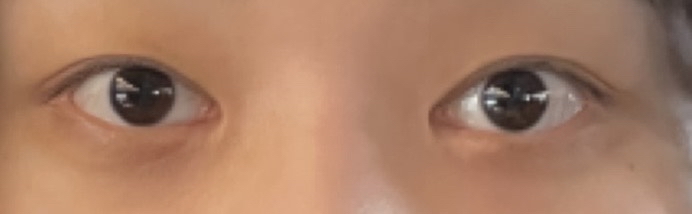 쌍꺼풀(절개) 후기