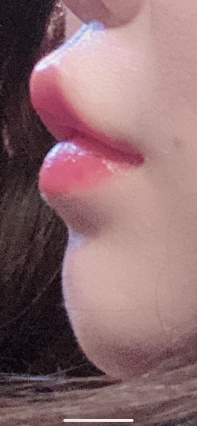 인중축소술 후기