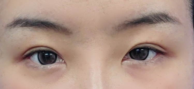 눈재수술 후기