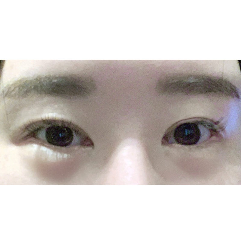 밑트임 후기