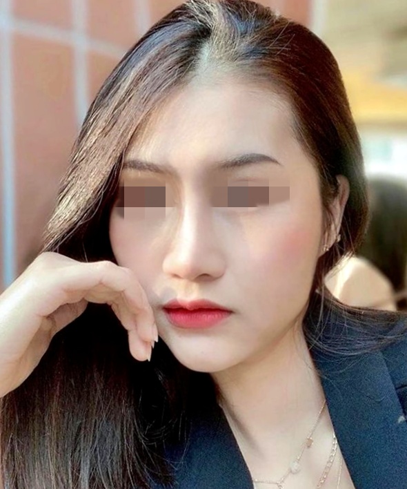 콧대(보형물) 후기